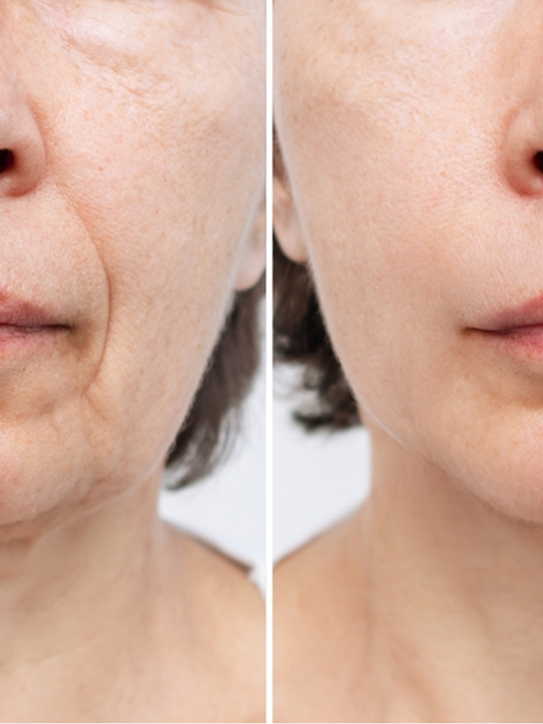 Before and after results of scar revision and aging-related surgeries at Sukriti Hospital in Bharuch. Dr. Vihang Sukhadia's expertise in wrinkle removal and facial rejuvenation.