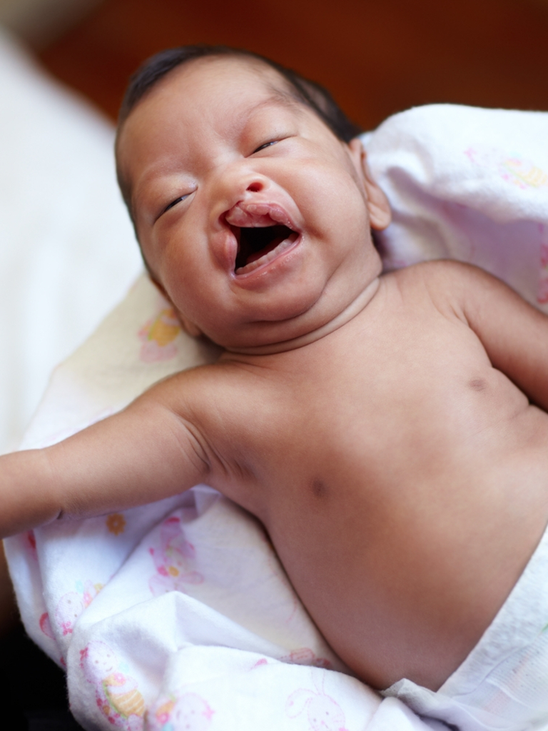 Infant with cleft lip before surgery at Sukriti Hospital in Bharuch. Dr. Vihang Sukhadia specializing in cleft lip and palate correction surgeries.