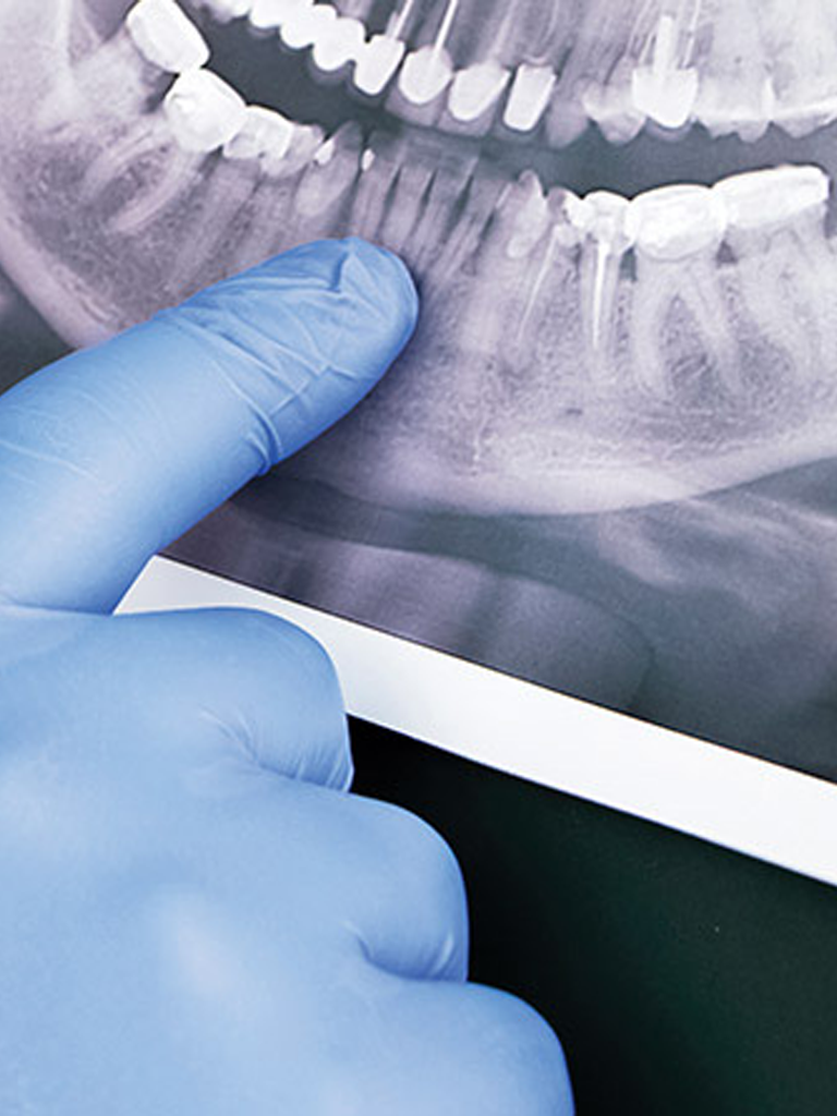 X-ray illustration of a jaw cyst removal procedure at Sukriti Hospital in Bharuch. Dr. Vihang Sukhadia specializing in minimally invasive jaw cyst treatments.