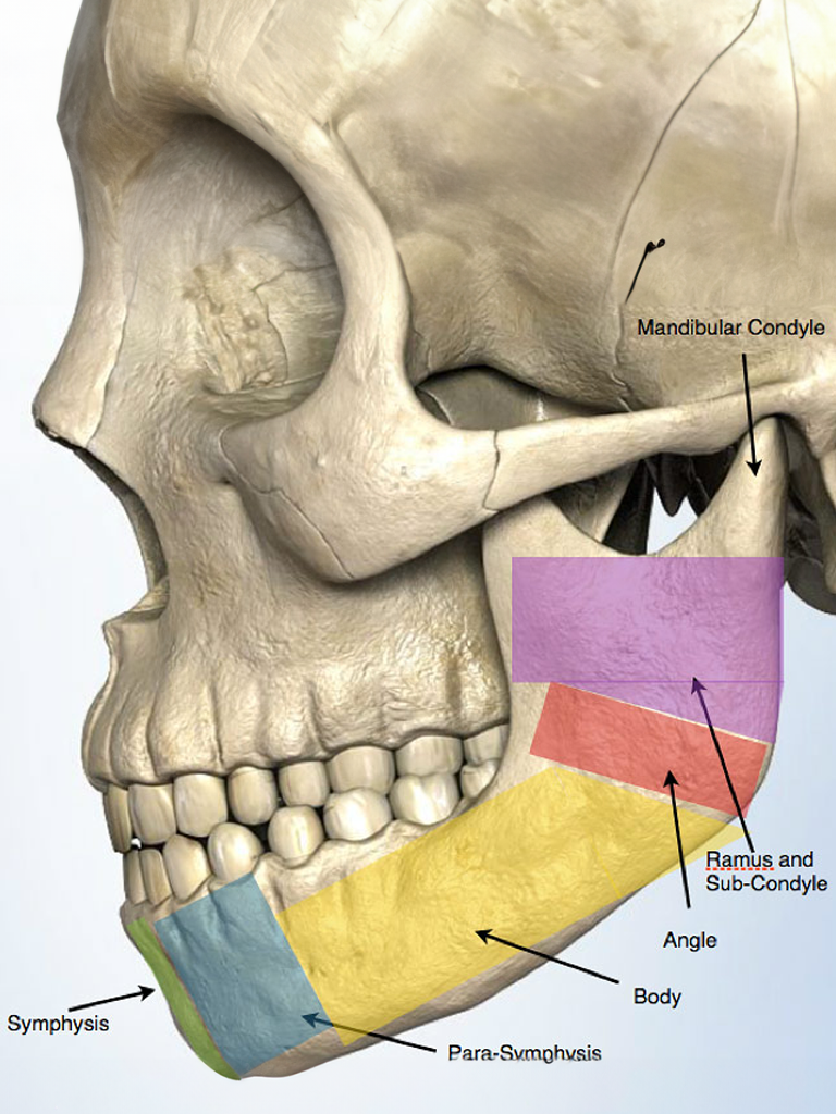 Side profile of a patient with a lower jaw fracture treated at Sukriti Hospital in Bharuch. Advanced techniques for restoring jaw function without prolonged immobilization by Dr. Vihang Sukhadia.