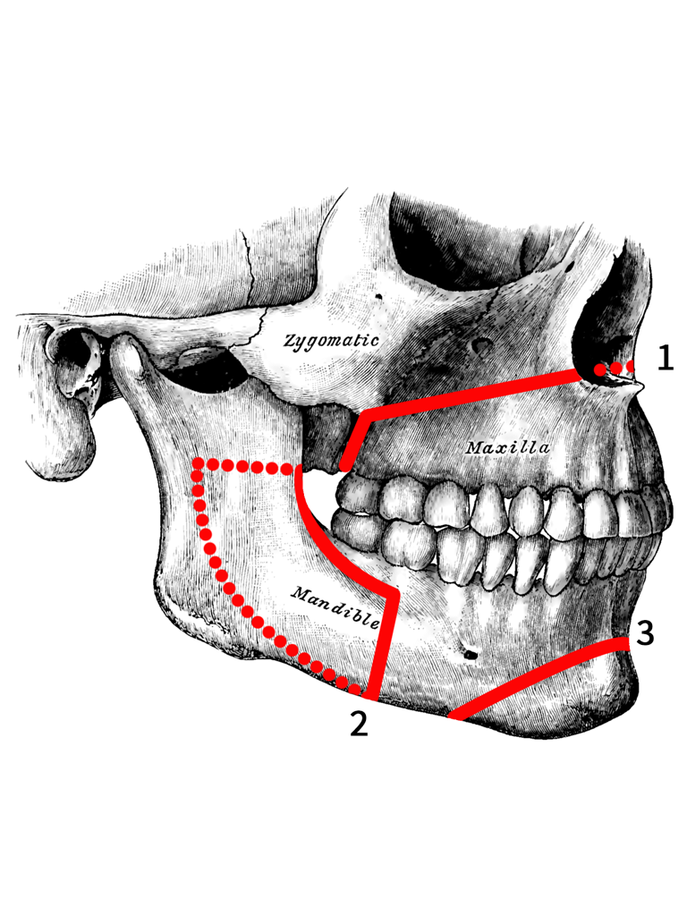 Patient with jaw bone defects before orthognathic surgery at Sukriti Hospital in Bharuch. Dr. Vihang Sukhadia specializing in corrective jaw surgery for functional and aesthetic improvement.