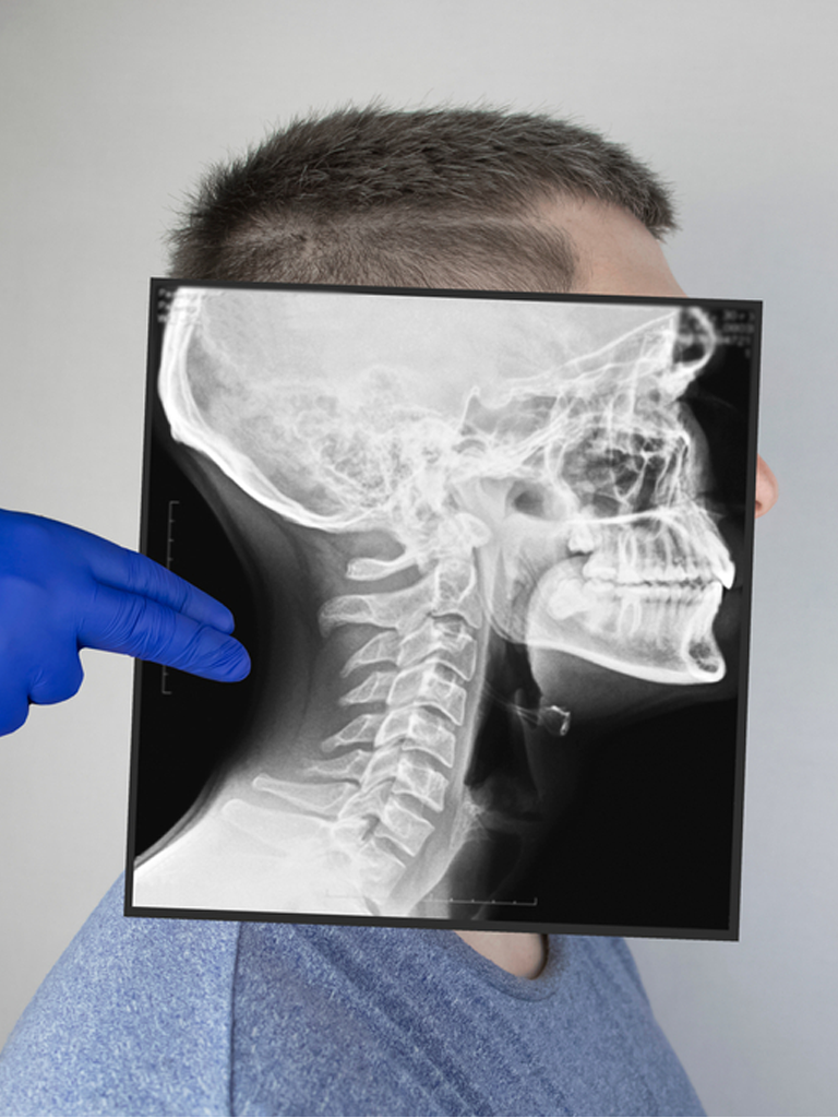 X-ray of a patient's facial fractures treated at Sukriti Hospital in Bharuch. Dr. Vihang Sukhadia specializing in upper jaw, cheek, nose, and eye socket fractures.