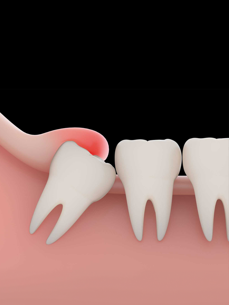 Patient undergoing wisdom tooth removal at Sukriti Hospital in Bharuch. Dr. Vihang Sukhadia performing advanced dental extractions for pain relief and oral health.
